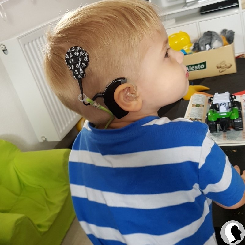 CI Kopf 2018 männlich Kind